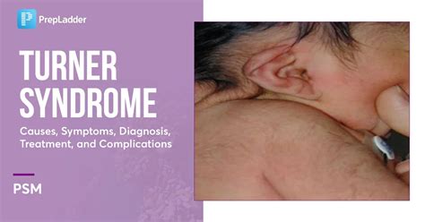 Turner Syndrome: Causes, Symptoms, Diagnosis, Treatment and Complications