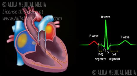 Ecg Carly Gif – NBKomputer