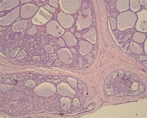 Histology of primary cutaneous adenoid-cystic carcinoma | Download ...