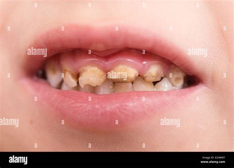 child bad teeth Stock Photo - Alamy