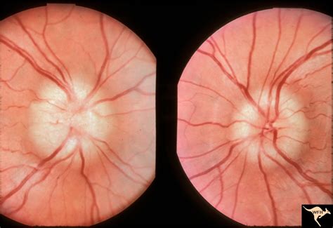 Bilateral Papilledema with Pseudotumor Cerebri | Eccles Health Sciences ...