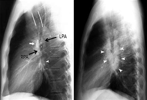 Normal Lateral Chest Xray