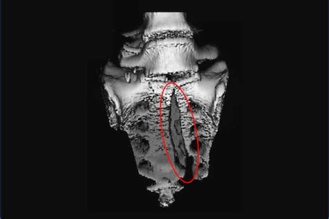 Sacrum fracture