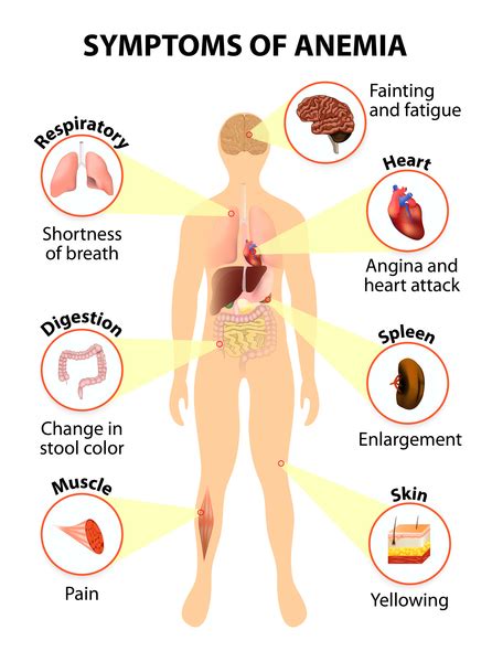 Iron-refractory iron deficiency anemia: MedlinePlus Genetics