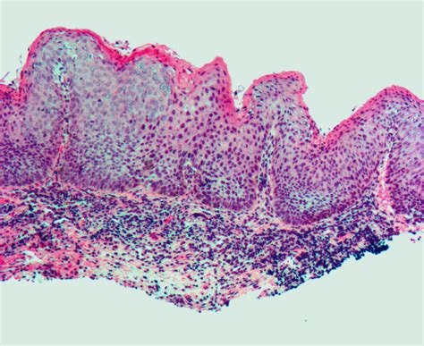 Vulvar intraepithelial Neoplasia(VIN) Pictures, Treatment, Symptoms