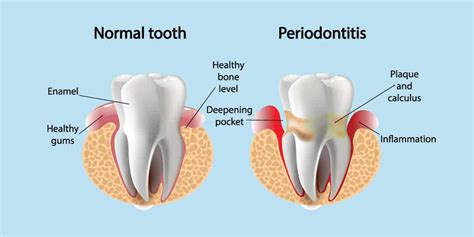 10 Important points about Periodontal Pocketing