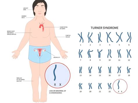 Turner Syndrome- Symptoms, Causes, Treatments, & More