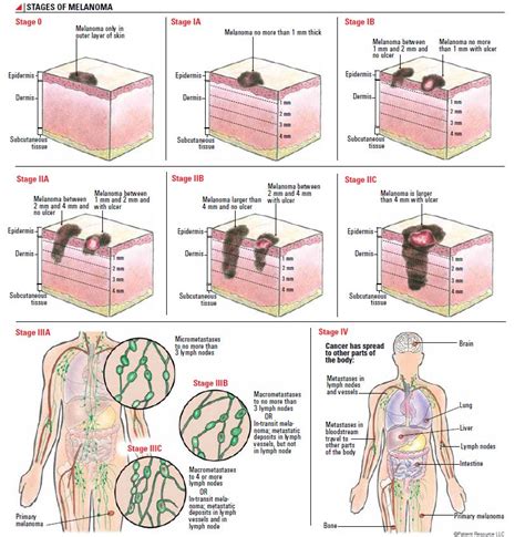 Staging Melanoma - Society for Immunotherapy of Cancer (SITC)