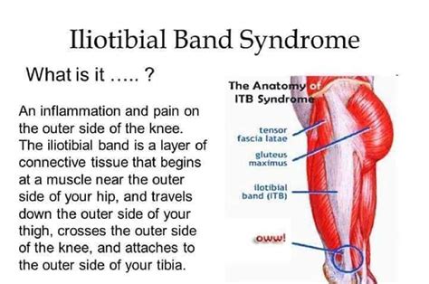 SOLUTION: It band syndrome - Studypool