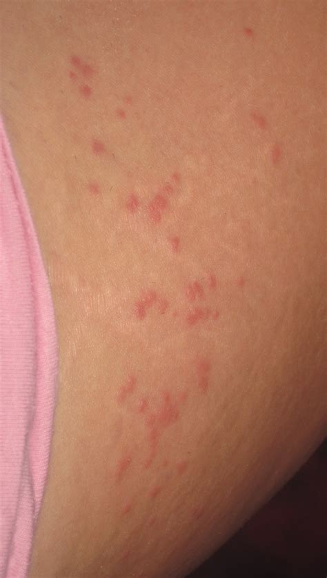 I have small itchy red bumps on my skin, any idea what this can be? They look like ant bites but ...