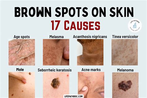 Brown Spots on Skin: 17 Causes, Pictures, Treatment