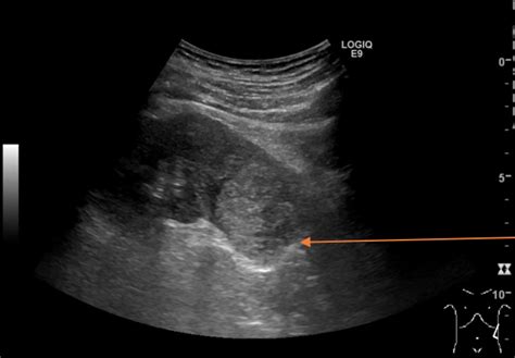 Kidney Ultrasound Tumor