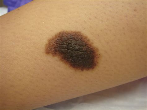 Congenital melanocytic nevus