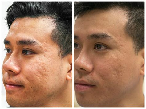 Acne Scar Treatment: CO2 Laser + Infini Results after a couple sessions