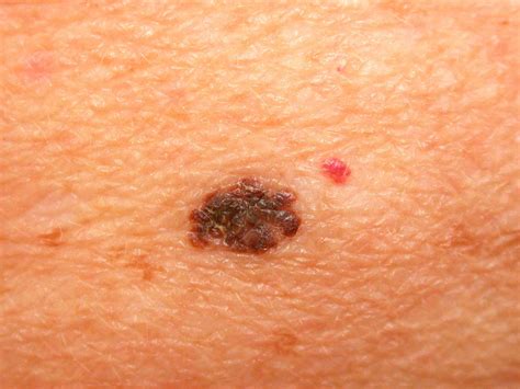 Early-Stage Melanoma: Skin Cancer Treatment