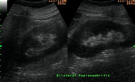 Pyelonephritis Ultrasound