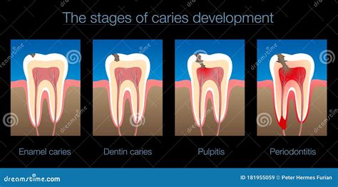 THE STAGES OF CARIES DEVELOPMENT Cartoon Vector | CartoonDealer.com ...