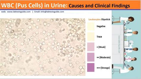 WBC (Pus Cells) In Urine: Causes, And Clinical Findings | Lab Tests Guide