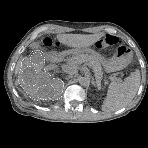 Pyelonephritis CT scan - wikidoc