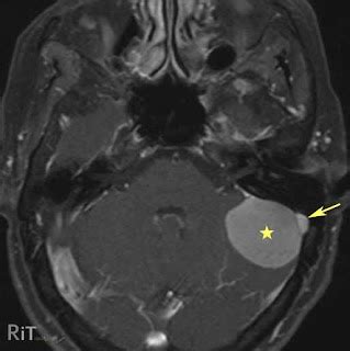 RiT radiology: Meningioma