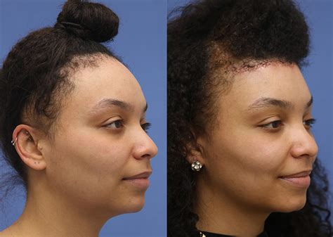 Forehead Reduction Before and After 01