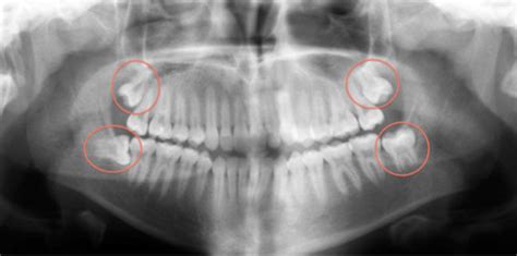 Impacted Wisdom Teeth Panoramic X Ray - TeethWalls