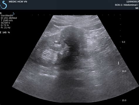 VIETNAMESE MEDIC ULTRASOUND: CASE 457: AML KIDNEY TUMOR, Dr PHAN THANH HẢI, Dr NGUYỄN HOÀNG ĐỨC ...