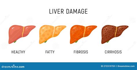 Liver Damage Infographic Diagram Cancer Disease Anatomy. Liver Damage Organ Tissue Hepatic ...