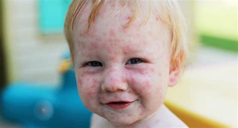 The chicken pox vaccine | BabyCenter