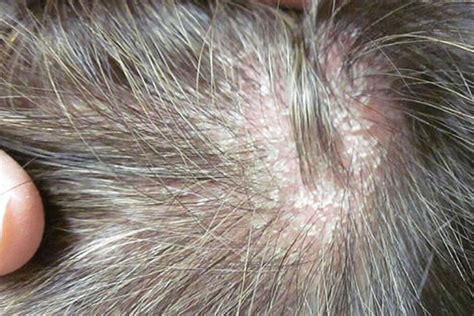 Scalp Psoriasis Symptoms Images - Infoupdate.org