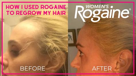 Rogaine for Women Before and After - YouTube