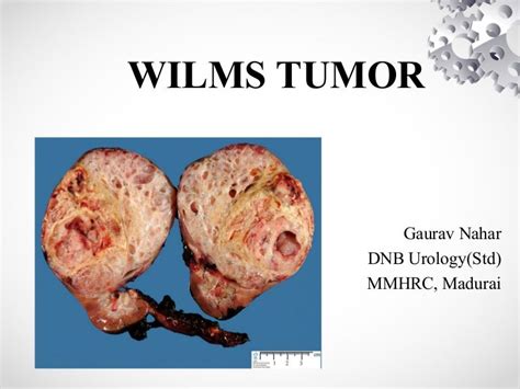 Wilms tumor