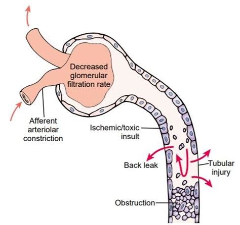 Pathogenesis of acute tubular necrosis. Sloughing and necrosis of... | Download Scientific Diagram