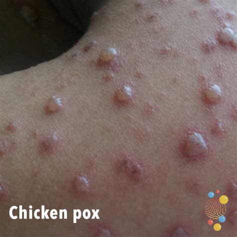 Chicken Pox In Adults Stages - kevinjoblog