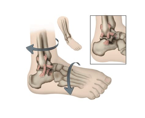 Sprained Ankle - OrthoInfo - AAOS