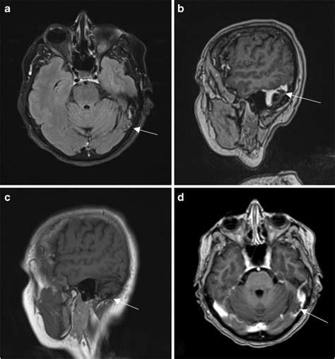 Arachnoid granulations should not be mistaken for thrombus. Axial T2w... | Download Scientific ...