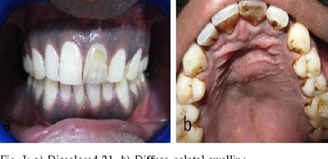 [PDF] Management of a Large Periapical Cyst : A Case Report | Semantic Scholar