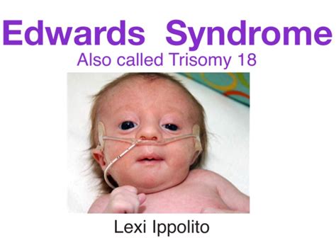 Edwards Syndrome Also Called Trisomy 18 Overview Symptoms Treatments | Images and Photos finder