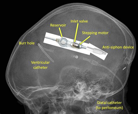 Cerebrospinal shunts - Questions and Answers in MRI