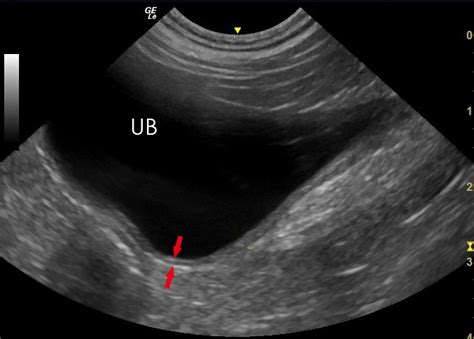 Normal Bladder Ultrasound