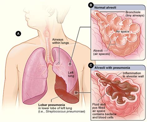 Pneumonia - What Is Pneumonia? | NHLBI, NIH