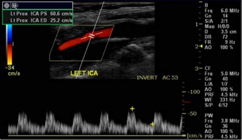 Carotid Ultrasound Table