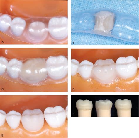 Temporary Crowns | Pocket Dentistry