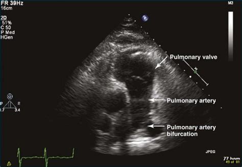 Pulmonary Valve in Health and Disease | Clinical Gate