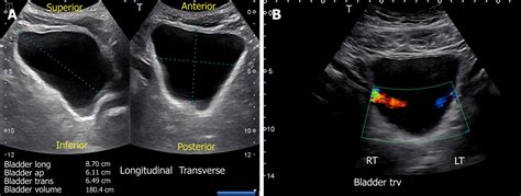 Renal Bladder Ultrasound