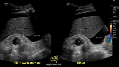 Short story of a complex renal cyst – NephroPOCUS