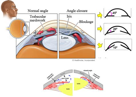 Narrow angles and laser peripheral iridotomy - Information on Eye Disorders by Dr Deans