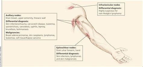 Unexplained Lymphadenopathy: Evaluation and Differential Diagnosis | AAFP