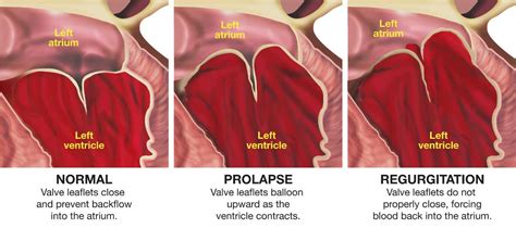 Mitral Valve Prolapse - Dysautonomia-MVP Center - Paula Moore M.D.