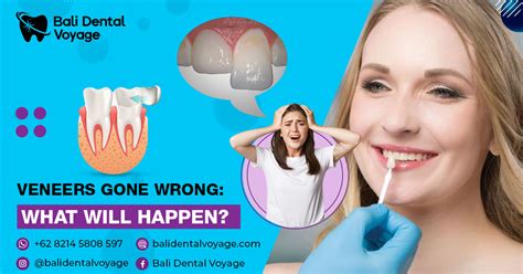 6 Signs of Bad Veneers: Veneers Gone Wrong | Bali Dental Voyage